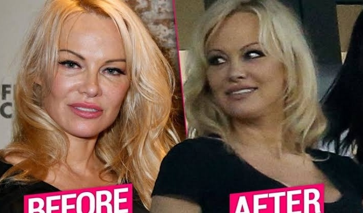 Pamela Anderson's Plastic Surgery