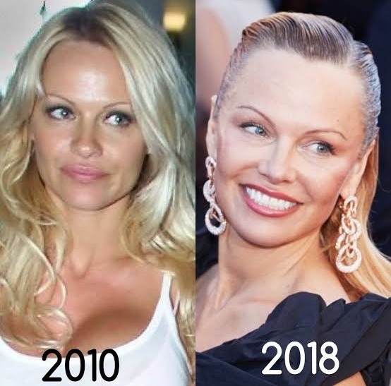 Pamela Anderson's Plastic Surgery