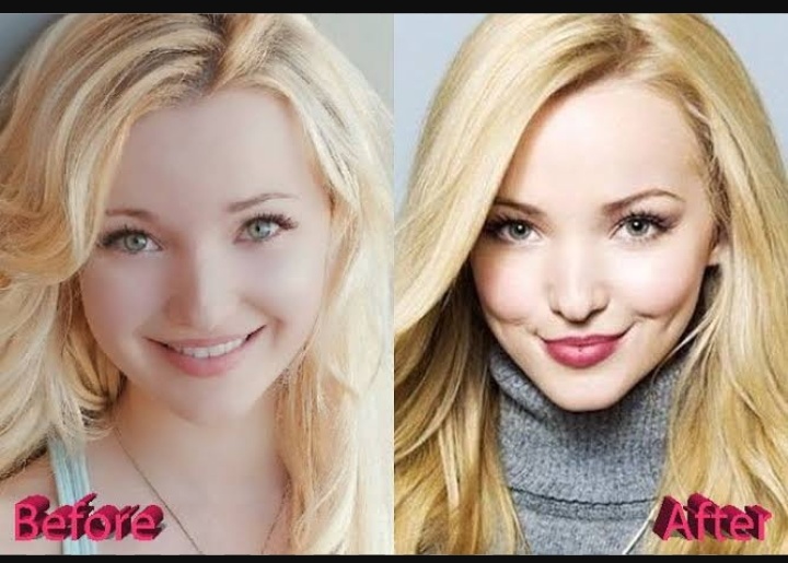 Dove Cameron Before Plastic Surgery